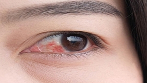 Göz kızarıklığı ve kanlanması nedir
