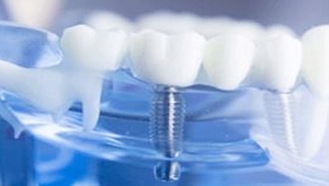 İmplant Tedavileri