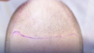  Saç Ekimi ve Saç Sağlığı