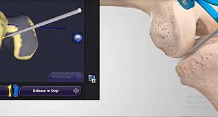 Diz Protezi Ameliyatlarında